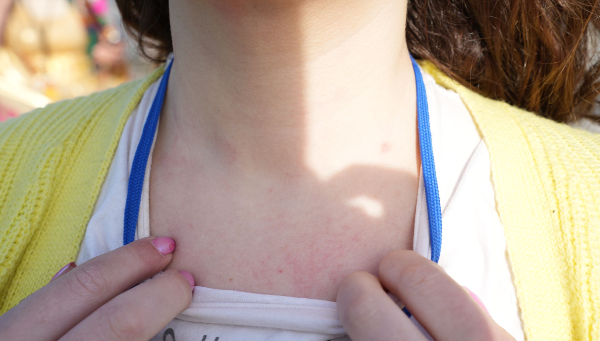 Yılmaz has received bruises around her neck due to police intervention.